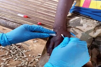 First Mpox related death reported in Yambio as hospitals struggle to contain virus